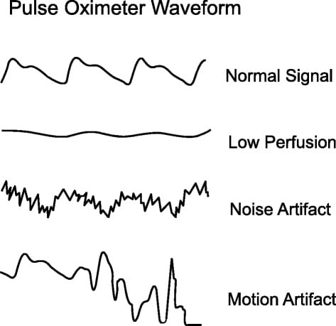 Pulse Oximeter Waveform