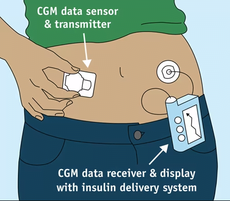 How does a CGM work