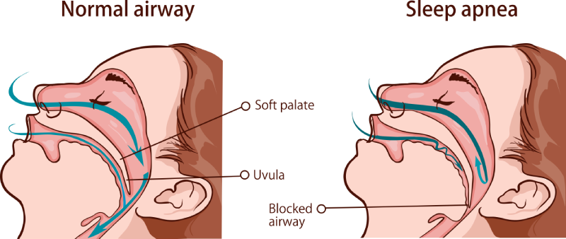 What Disease Can portable oxygen concentrator Treat During Sleeping